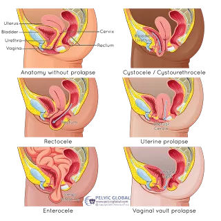 Pelvic Organ Prolapse & Hypermobility: Why It Happens & What You Can Do