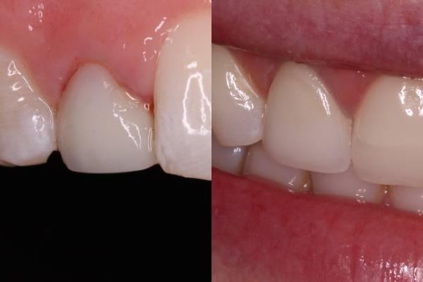 Why Choose a Direct Composite Restoration Over A Conventional Crown?