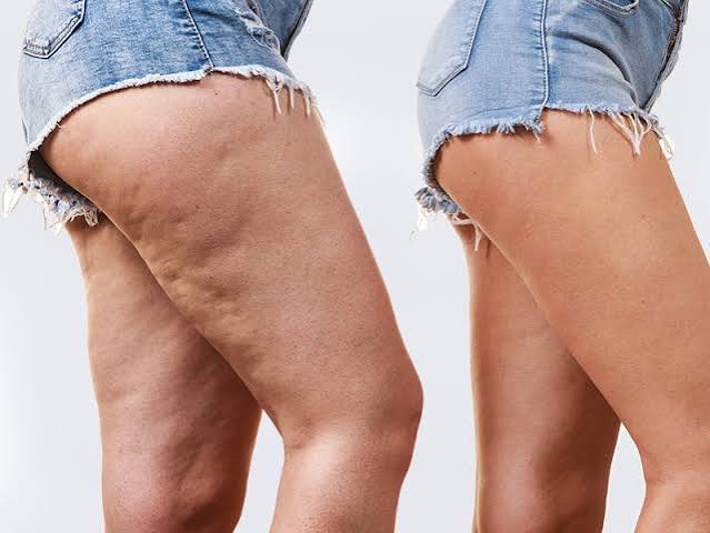 The Real Reason Cellulite Won’t Go Away (and How Contour Light Fixes It)