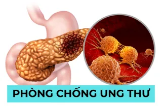 Phòng Chống Ung Thư: Bảo Vệ Sức Khỏe