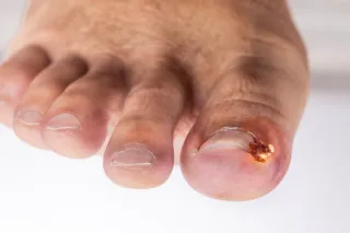 Surgical Options for Ingrown Toenails: When Is Nail Avulsion Necessary?