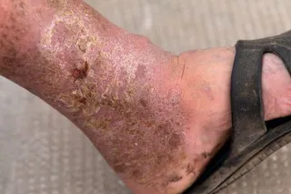 How Podiatrists Treat Foot Ulcers: Effective Solutions for Healing and Prevention