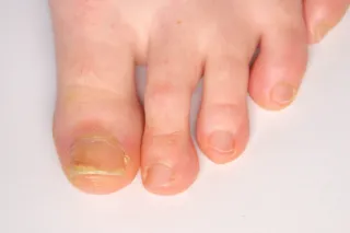 Why Are My Toenails Getting Hard and Yellow?