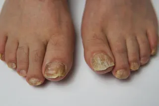 Thick, Brittle Toenails? Let’s Get to the Root of It