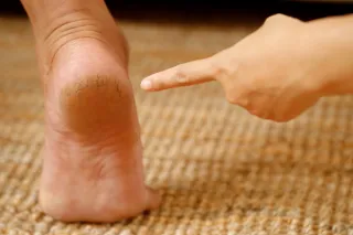 Cracked Heels: Why They Happen and How to Heal Them