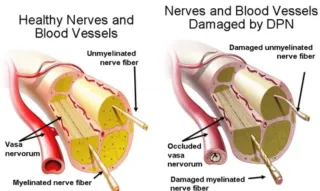 The Link Between High Blood Glucose Levels and Diabetic Neuropathy: Unraveling the Connection