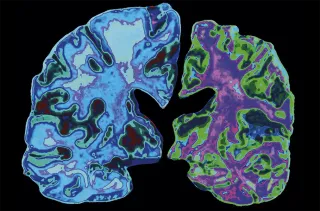 Stem Cell Therapy: A New Hope for Alzheimer’s Disease and Dementia