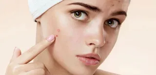 HƯỚNG DẪN CÁCH NẶN MỤN HIỆU QUẢ KHÔNG ĐỂ LẠI SẸO RỖ, LÕM, THÂM MỤN VÀ VIÊM DA