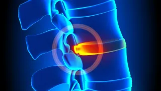 Can a chiropractor fix a bulging disc?