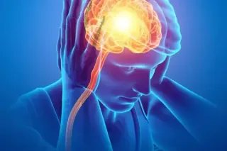 Migraines