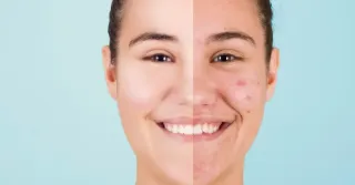 Best Acne Treatment Options in Greenville, SC – Expert Advice from Skin By Kim