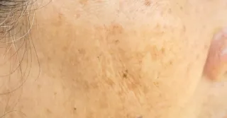 Effective Hyperpigmentation Treatments in Greenville, SC – Fade Dark Spots Naturally