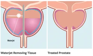 Aquablation: A Revolutionary Treatment for Prostate Enlargement
