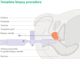 Prostate Cancer Diagnosis: The Role of MRI-Template Biopsies