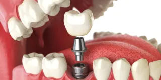 Missing Bone for Implants? Bone Grafting in New York