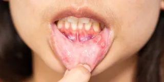 Oral Biopsy in New Jersey for Lumps or Sores