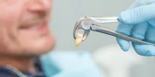 Fear of Wisdom Teeth Removal — What Englewood Patients Should Know