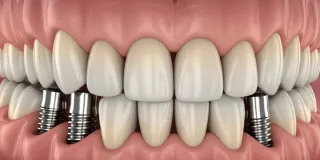 All-on-Four Dental Implant Cost in Englewood