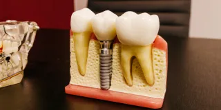 Learn how same-day dental implants in Englewood work