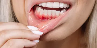 Gum Recession Surgery in Englewood: Causes and Recovery Guide