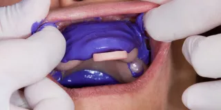 Are You a Candidate for Full Mouth Rehabilitation? Signs You Need Full Mouth Reconstruction in Englewood, NJ