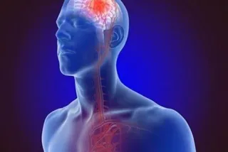 The Link Between Obstructive Sleep Apnea and Heart Attacks and Strokes During Sleep