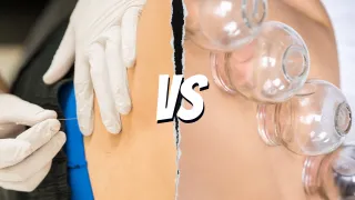 Dry Needling vs. Cupping