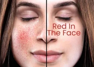 Red in the Face? You May Have Rosacea