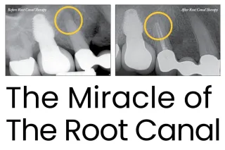 The Miracle of the Root Canal