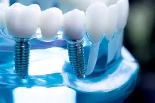 The Complete Guide to Dental Implant Recovery: What to Expect and How to Speed Up the Process