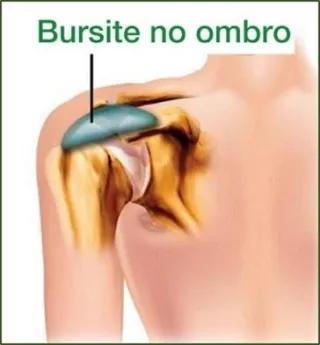 O que é Bursite? | IORB Instituto de Ortopedia