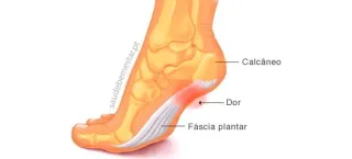 O que é Fascite Plantar? Causas, Sintomas e Tratamentos | IORB