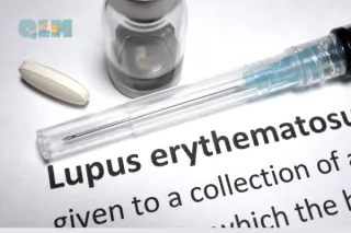 Living with Lupus: How to Manage Symptoms and Improve Quality of Life