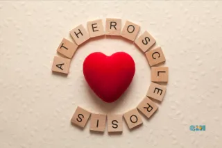 Why Inflammation—Not Just Cholesterol—Drives Heart Disease

