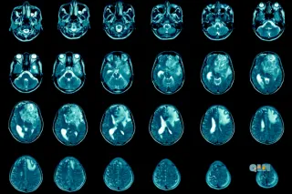 Starving Cancer: Dr. Thomas Seyfried’s Metabolic Therapy for Glioblastoma

