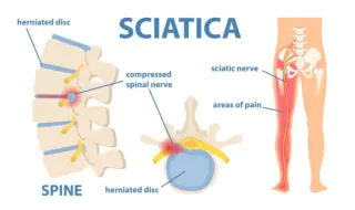 Can Chiropractic Help Sciatica?