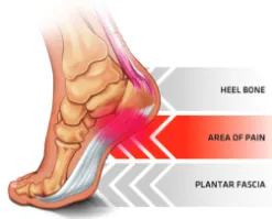 Relief for Your Feet: Chiropractic Care and MLS Laser Therapy for Plantar Fasciitis"