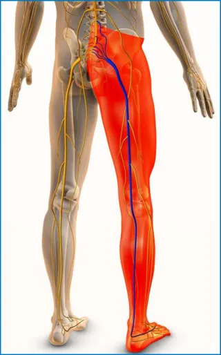What Causes Sciatica? Natural Relief for Evansville & Newburgh Residents