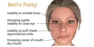 Treatment for Bells Palsy Evansville Indiana