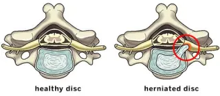 Ruptured Disc in Lower Back? Non-Surgical Relief for Sciatica and Herniated Discs in Evansville