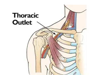 Advanced Treatment for Thoracic Outlet Syndrome in Evansville & Newburgh – Laser & Shockwave Therapy