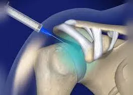 Shoulder Pain Relief in Evansville | Lobacz Chiropractic
