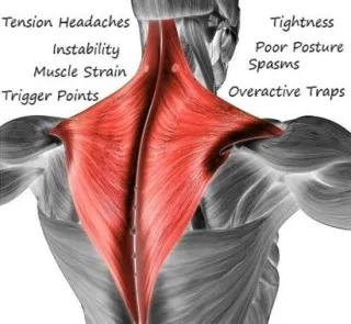 Trap Muscle Headache Relief | Lobacz Chiropractic Evansville