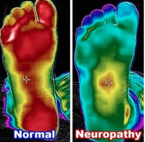 Living With Neuropathy? A Non-Surgical Approach to Nerve Pain Relief