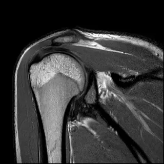 When an MRI Is (and Isn’t) Necessary for Shoulder Pain