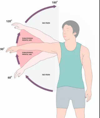 Shoulder Impingement: What It Really Means and How to Fix It