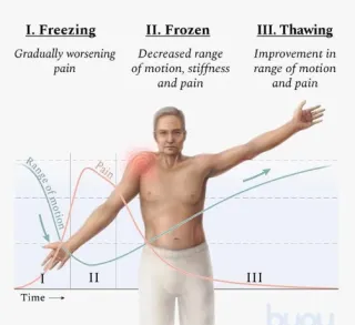 Frozen Shoulder: Early Signs, Stages, and What to Do