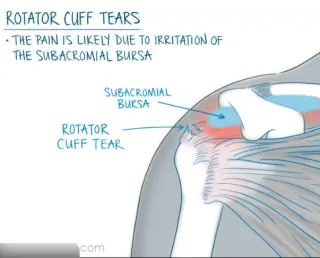 Shoulder Pain After Sleeping Caused by Pillow and Sleeping Mechanics