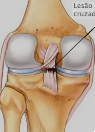 Lesão do Ligamento Cruzado Anterior: Causas, Sintomas e Tratamentos | Dr. Jefferson De Decco