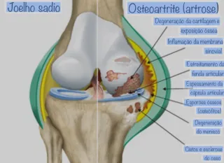Osteoartrite: O que é, Causas e Tratamentos | Dr. Jefferson De Decco